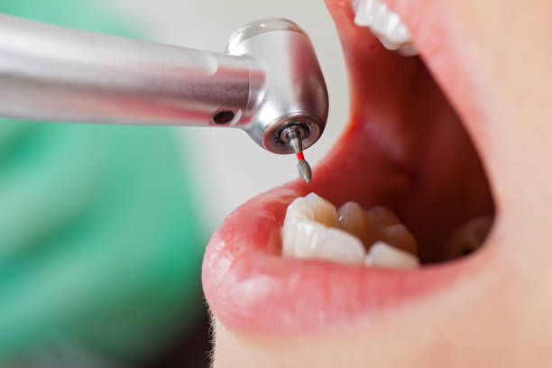 Best Emergency Treatment for Dental Infections or Abscesses in Sunray, TX